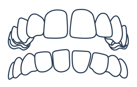 Gap in Teeth example for Invisalign